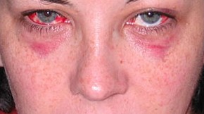 Strangulation is one of the most lethal forms of domestic violence where unconsciousness may occur within seconds and death within minutes. In this course we will discuss the Violence Against Women Act (VAWA), domestic violence, national and state statistics, signs and symptoms of strangulation, and interviewing and investigating strangulation. Cover pic